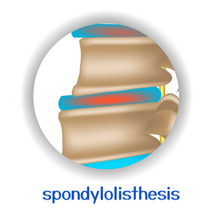 image of Montreal spondylolisthesis